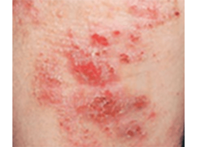 Dermatology - Atopic Dermatitis